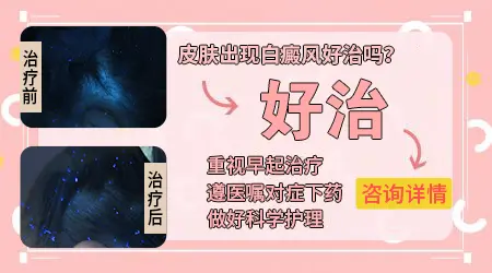 白癜风长在手背侧面好治吗