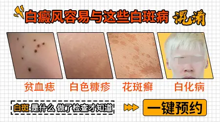 白癜风图片鉴别方法 医生私藏的辨图技巧分享