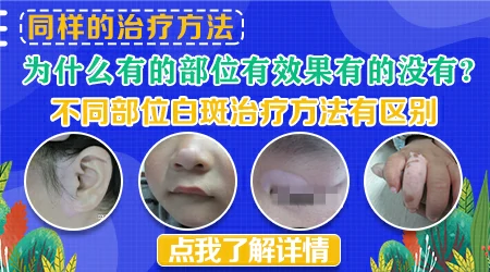 白癜风不同部位的治疗难度有区别吗