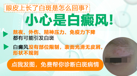 眼下白斑好几年了没见发展是白癜风吗