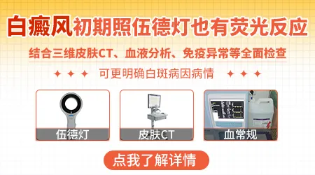 早期白癜风伍德灯检查结果是什么样
