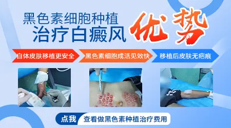 多年的白癜风白斑做黑色素种植还有效果吗