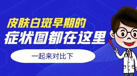 怎么识别婴儿白癜风