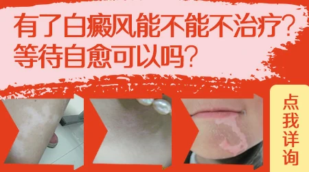 刚长白癜风白点状能自己恢复吗