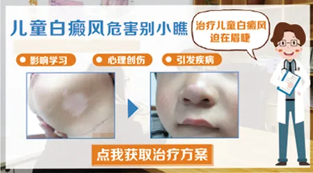 儿童白斑一定是白癜风吗