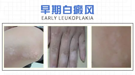 脖子浅白色白斑图片