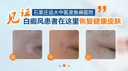 石家庄治疗白癜风厉害的医院
