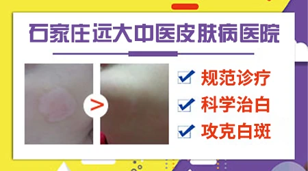 初期白癜风和白色糠疹怎么肉眼区分
