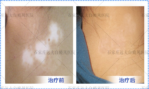 颈部白癜风一年了怎么治