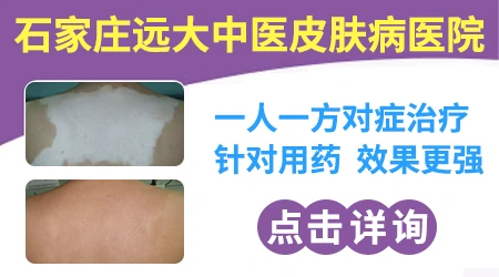 巴掌大白癜风发病半年复色概率有多高