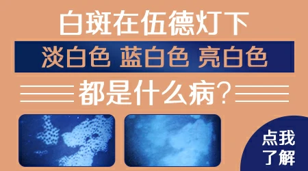 伍德灯下白斑显示亮白色就是白癜风吗