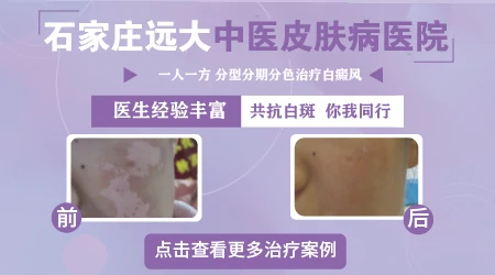 河北哪里治疗白癜风效果好