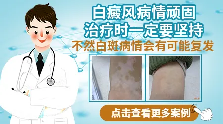 白癜风隔几天照一次308激光效果好