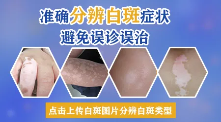 孩子手臂上有白斑早期的图片