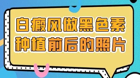 黑色素移植哪里的白斑医院可以做