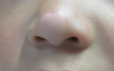 鼻梁那一块皮肤特别白是为什么