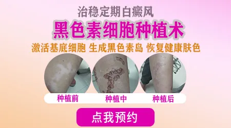 稳定期白癜风适合照308激光还是移植手术