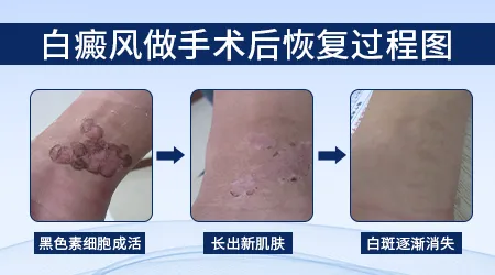白癜风除了吃药照光还有没有别的好方法