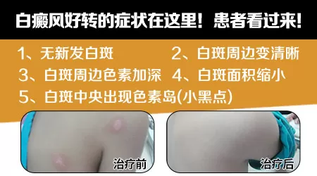 308激光治疗白癜风好转的表现