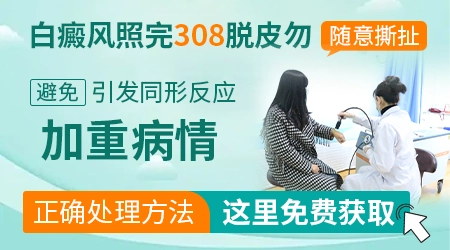 白癜风照光后脱皮还能不能涂药
