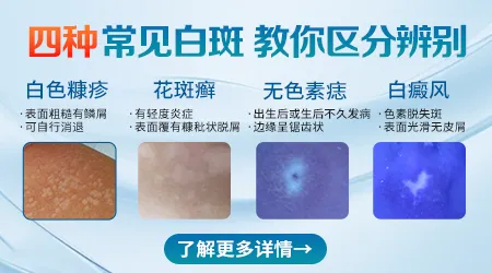 初期白癜风和普通的色素减退斑怎么区分