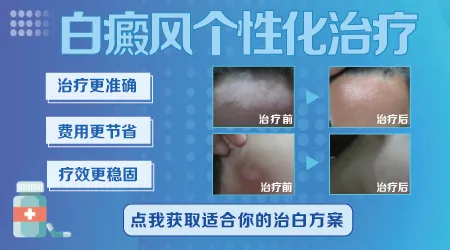 白癜风早期能治好的几率有多大