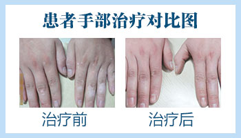 女性手部白癜风治疗前后的对比图