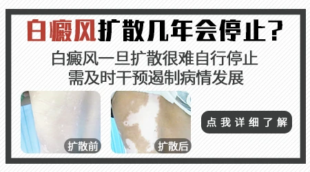 通常白癜风扩散多久会停止