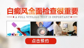 伍德灯检查白斑是不是白癜风准吗