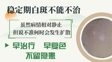 白斑稳定后能不能停止治疗
