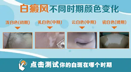 白癜风淡白云白瓷白色分别代表什么