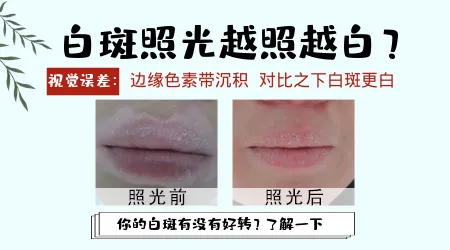 在治疗的期间白癜风会越来越白吗