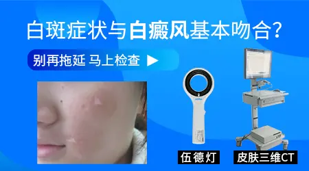 面部白癜风早期发病图片