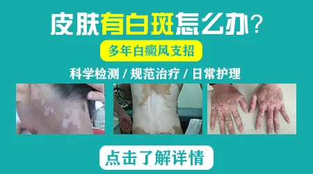 儿童脸上白癜风和虫斑图片对比