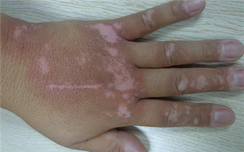 手指白斑初期症状图片
