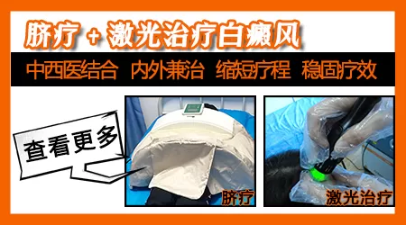 308激光治疗白癜风多久会见效