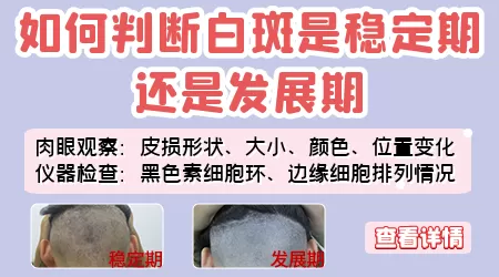 如何判断白斑是稳定期白癜风