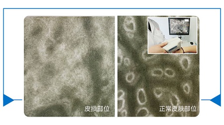 皮肤镜和皮肤ct的区别 哪个检查白斑准