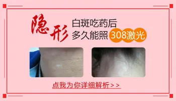 隐形的白癜风吃药能控制住不显现出来吗
