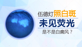 不确定是不是白癜风做哪些检查