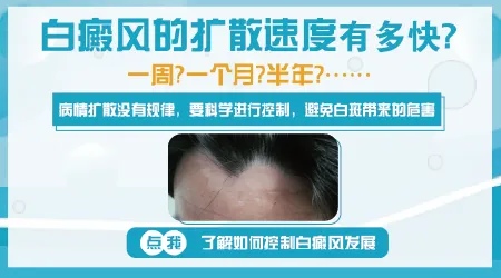 白癜风扩散速度快吗？从一小块到全身要多久