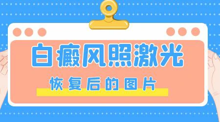 308激光治白癜风多久见效果