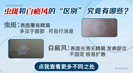 孩子脸上长小白斑怎么区分是虫斑还是白癜风