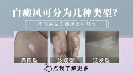 白癜风分哪几种类型 怎么区分自己的