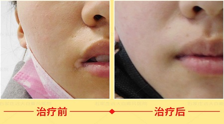 嘴角白癜风两个月了能照308激光吗