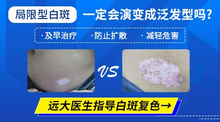 白癜风有哪几种类型