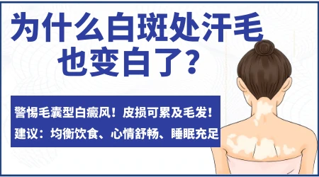白斑出汗毛变白一定是白癜风吗
