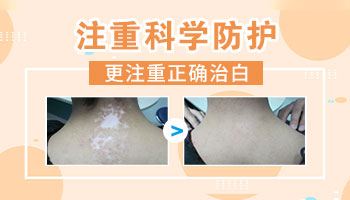 白癜风自我恢复的方法