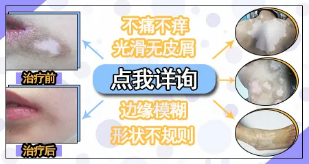 皮肤白斑边界模糊是早期白癜风吗