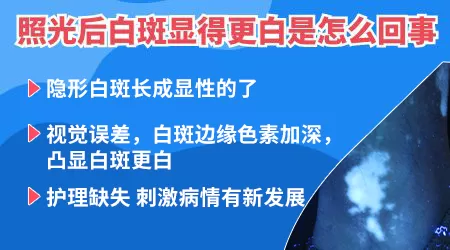 白癜风照308激光后更白了怎么回事